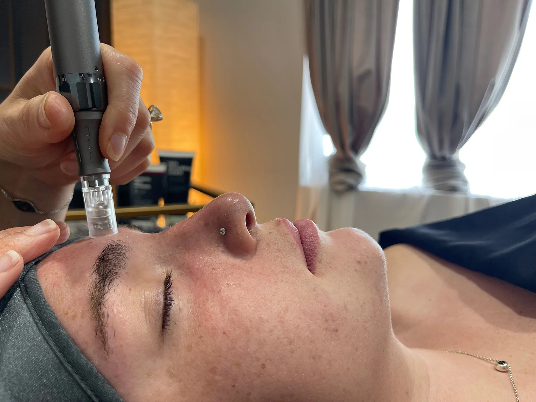 Microdermabrasion